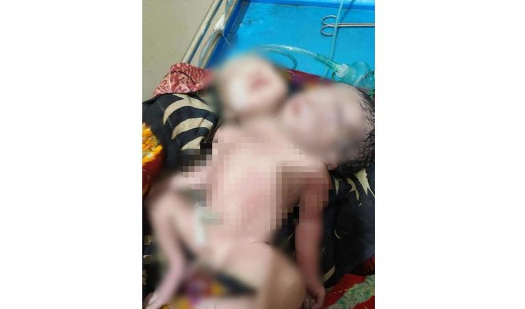 নেছারাবাদে দুই মাথাওয়ালা শিশুর জন্ম