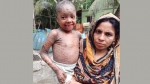 <small>বিরল চর্মরোগে আক্রান্ত</small> নাজিরপুরের শিশু তানিয়ার চিকিৎসা সহায়তা জরুরী