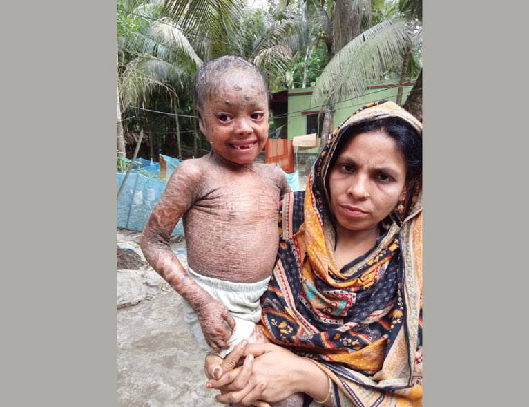 বিরল চর্মরোগে আক্রান্ত নাজিরপুরের শিশু তানিয়ার চিকিৎসা সহায়তা জরুরী