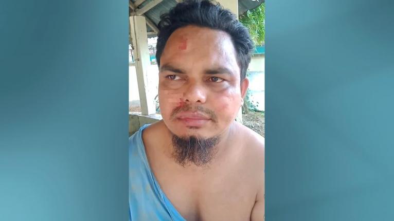 মনপুরায় মারধরের ঘটনায় আহত মাইক্রোবাসচালক ইব্রাহীম।